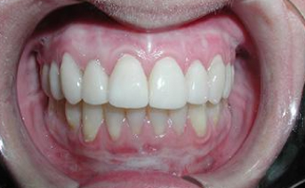 porcelain-veneers gallery