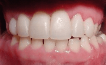 porcelain-veneers gallery