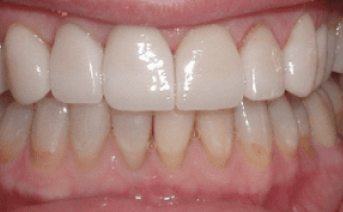 porcelain-veneers gallery