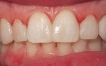 veneers gallery