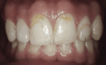 veneers gallery