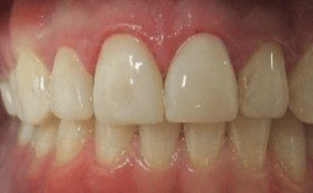 veneers gallery
