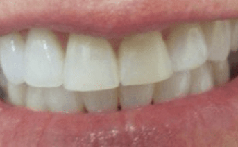 veneers gallery