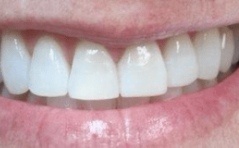 veneers gallery