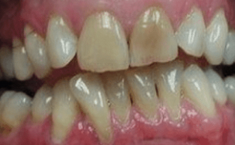 veneers gallery