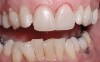 veneers gallery