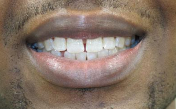 veneers gallery