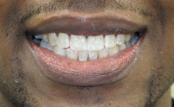 veneers gallery