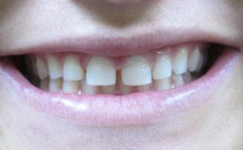 veneers gallery