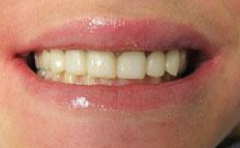 veneers gallery