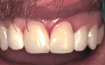 veneers gallery